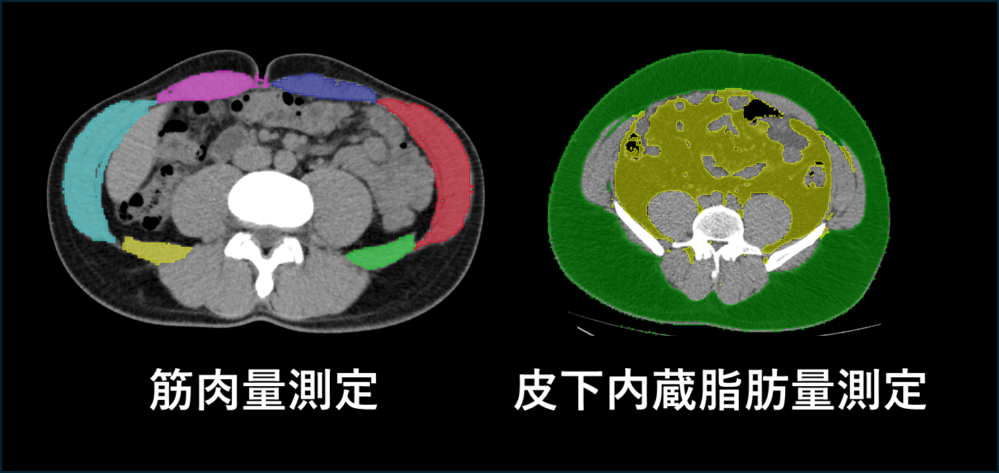 MVision bodyによるCT画像解析結果 - 胸腹部CT画像の可視化