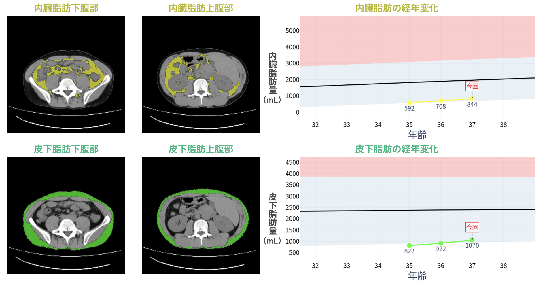 MVision bodyによる内臓脂肪の可視化 - CT画像からの脂肪量測定結果