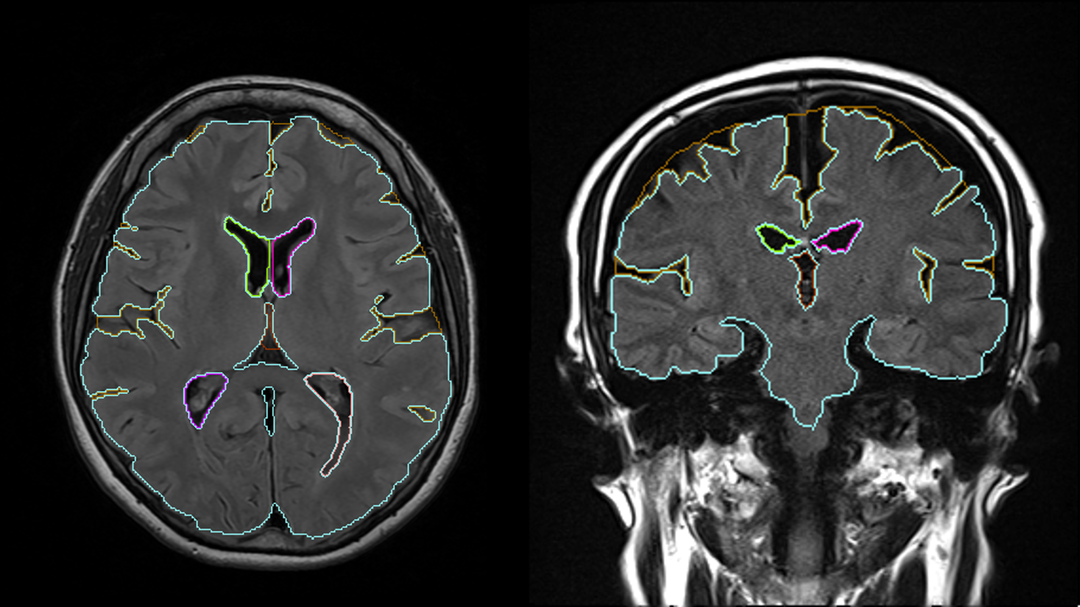 AI Analysis Atlas FLAIR