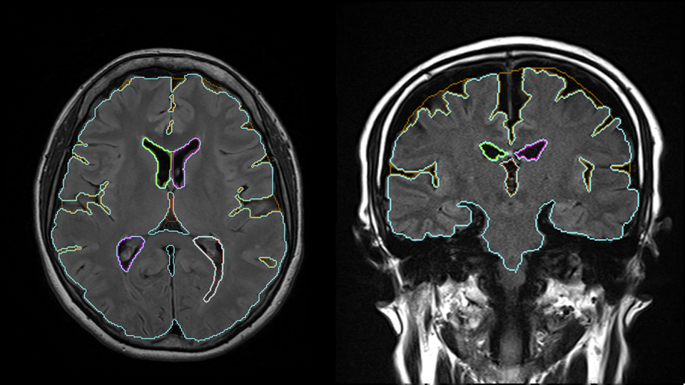 MVision healthによるMRI画像解析結果 - FLAIR画像での脳萎縮度測定