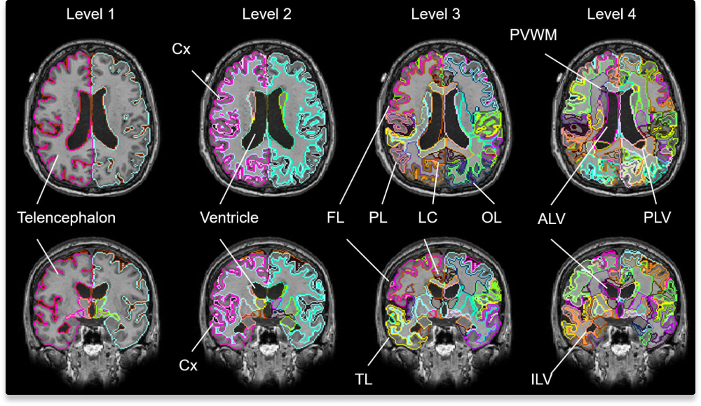 MVision healthによるMRI画像解析結果 - T1画像での脳構造可視化