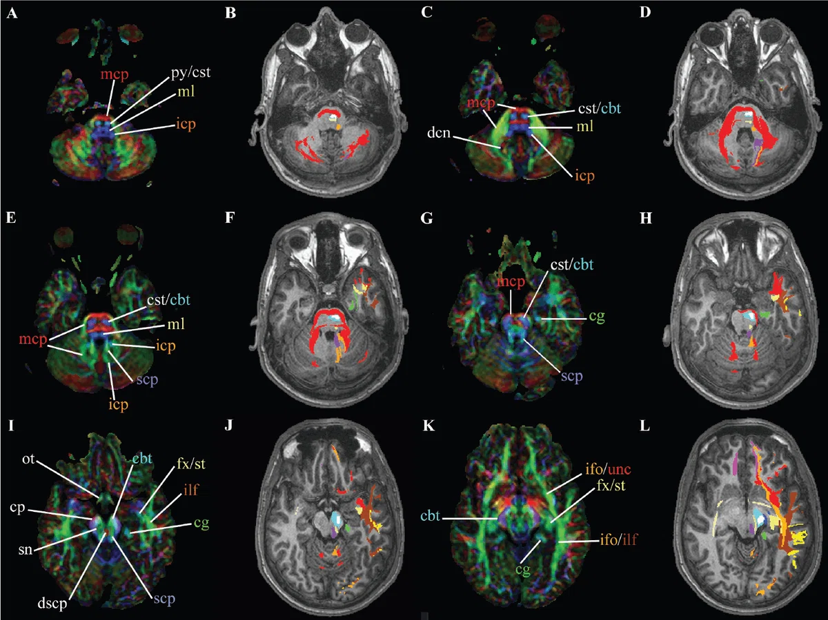 Tractography